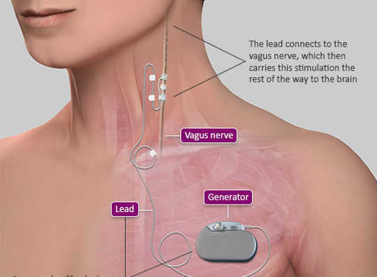 This Implant Zaps The Vagus Nerve Just Right To Treat Inflammation